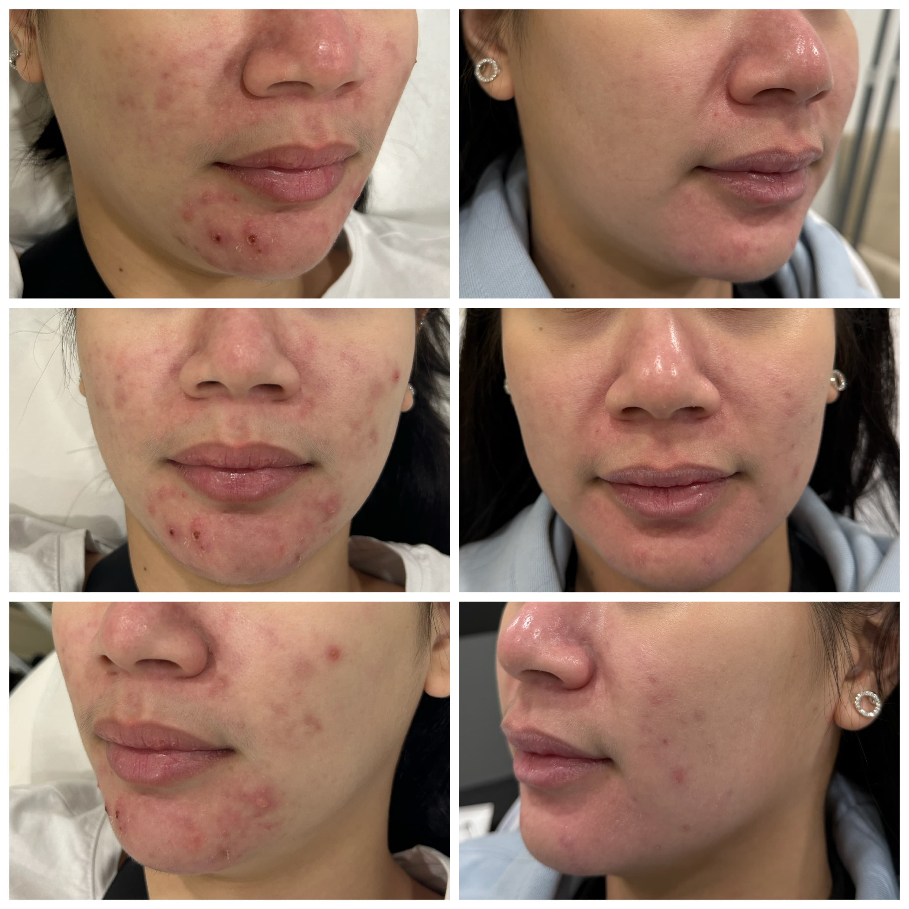 Acne Treatment